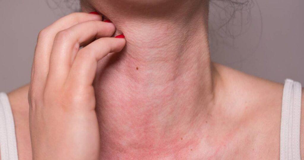Allergies
